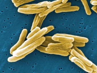 Туберкулез возвращается в Европу. Неутешительная статистика туберкулеза в 2011 году.