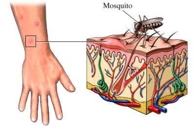 защита от комаров, аллергия