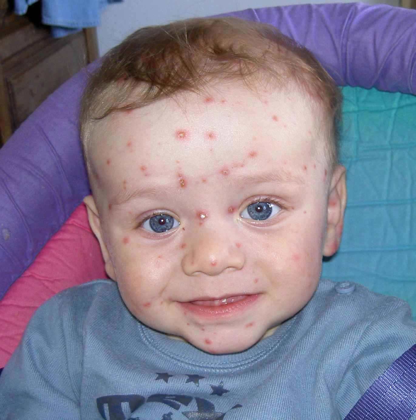 прыщи у ребенка, фото угрей на малыше, младенец с прыщами, картинки, acne child