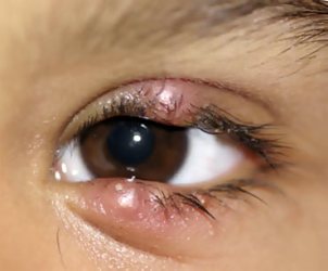 Как лечить ячмень на глазу? Как вылечить ячмень на глазу у ребенка