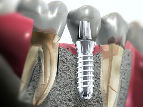 Имплантация зубов: отзывы пациентов и специалистов