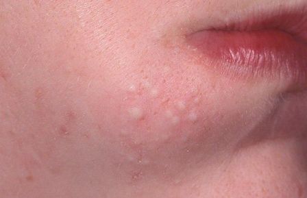 подкожные прыщи, лечение и причины появления, фото акне